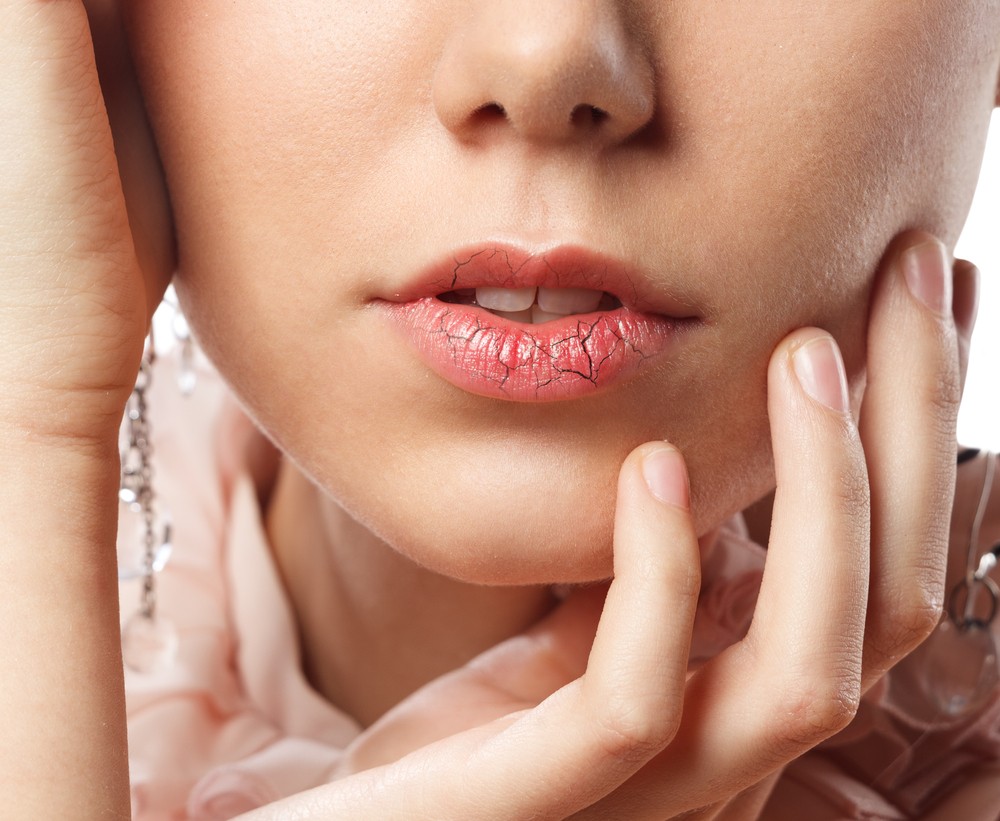 Как лечить потрескавшиеся губы зимой?